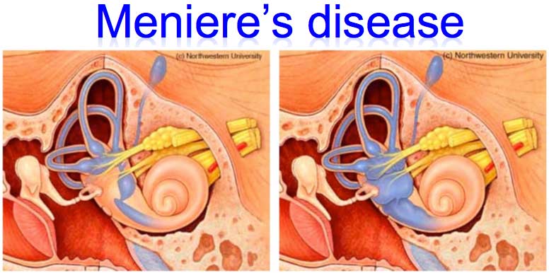 Meniere&#39;s Disease: Symptoms, Diagnosis, Management...